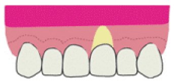 歯周整形治療3