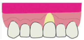 歯周整形治療4