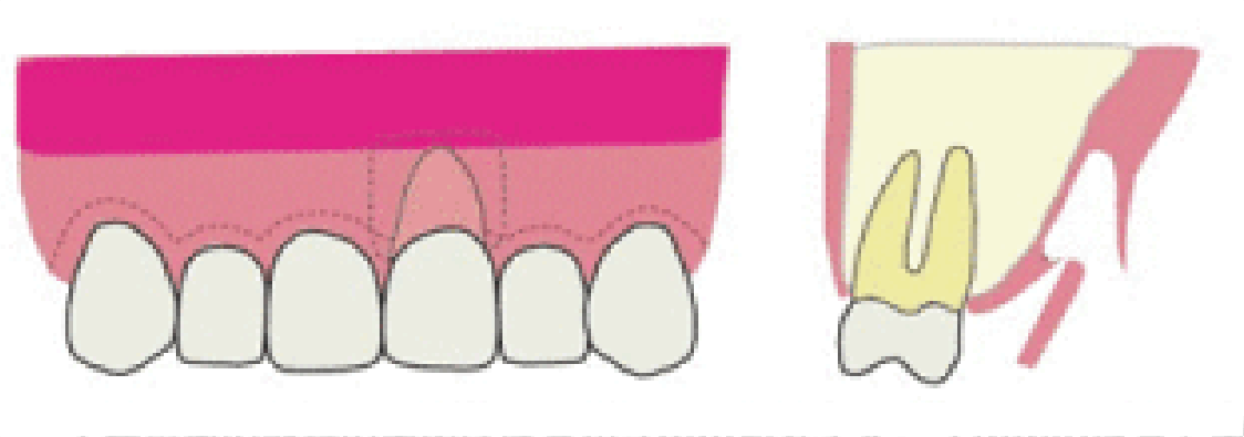 歯肉移植の手法2