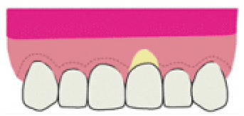 歯周整形治療1
