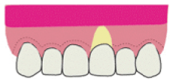 歯周整形治療2