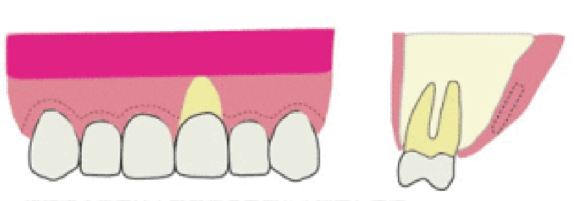 歯肉移植の手法1